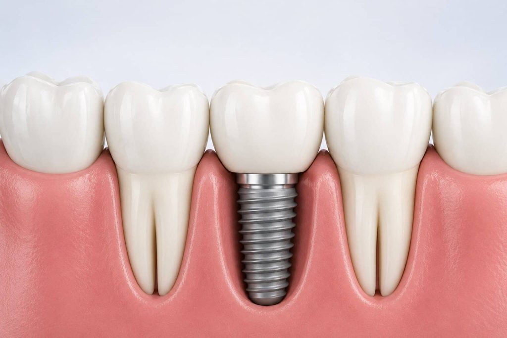 implante dental granada