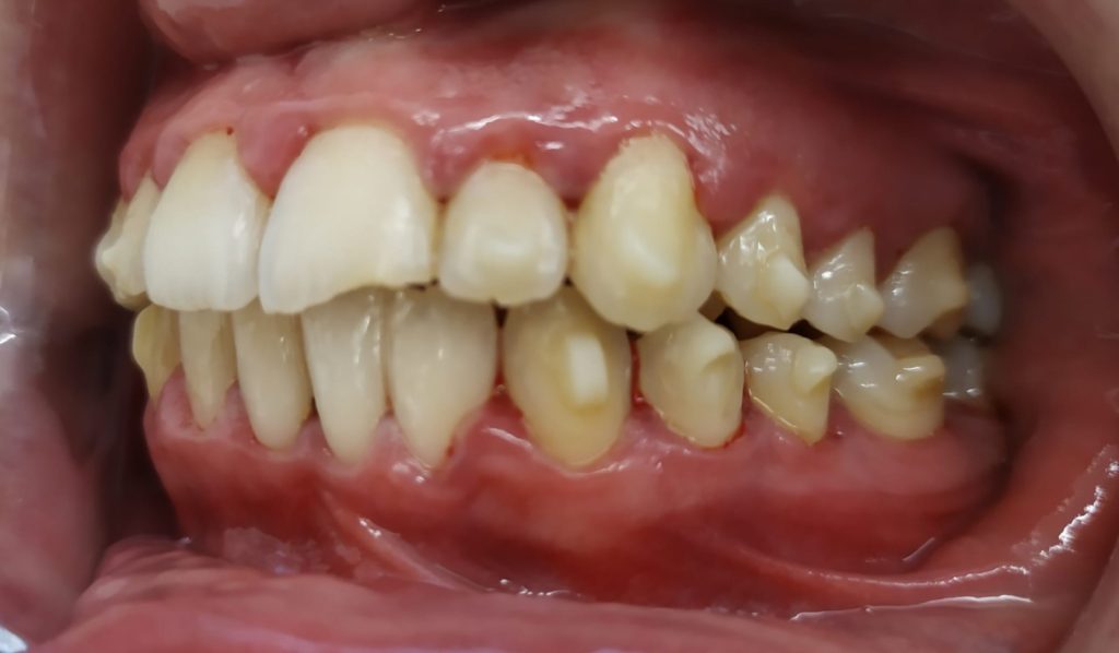 llevar brackets en granada