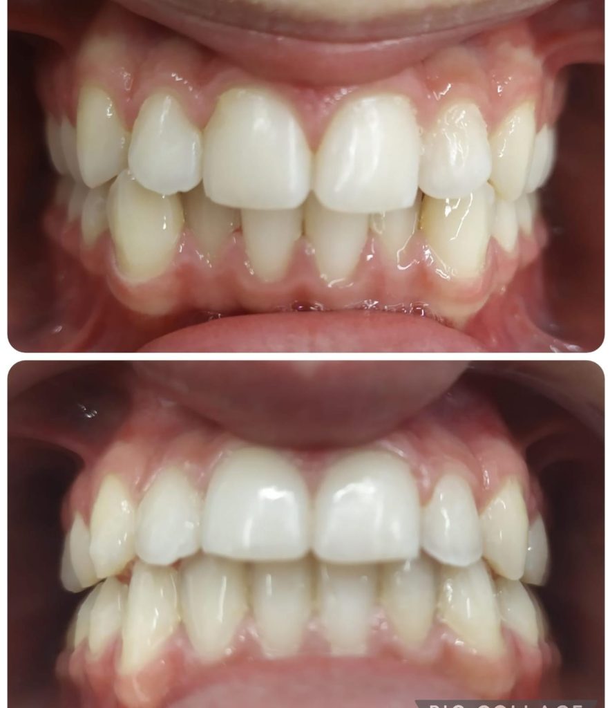 resultado de aparato de dientes invisible en granada