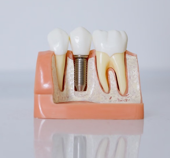 servicio de implantes dentales en granada