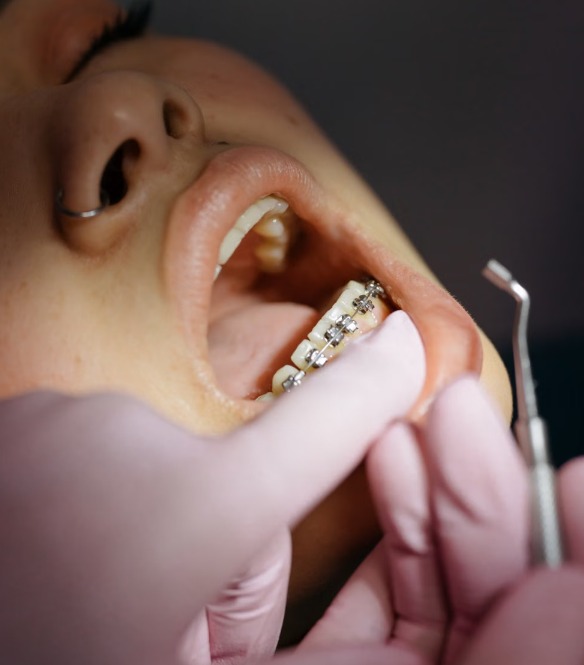 Servicio ortodoncia brackets granada