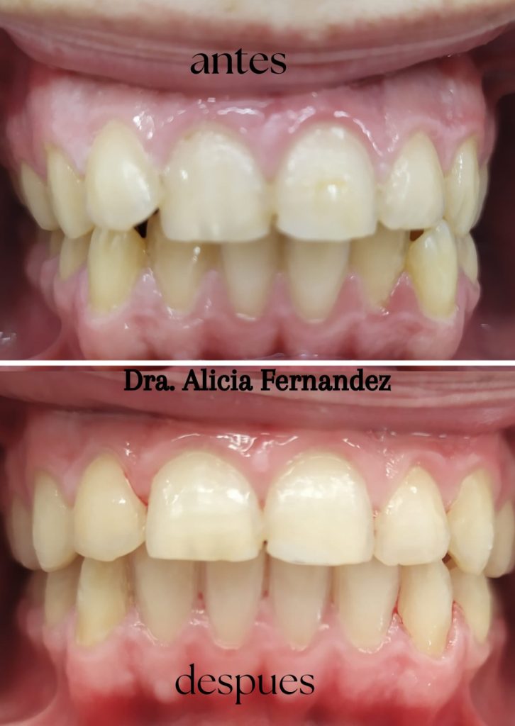 tratamiento invisalign granada