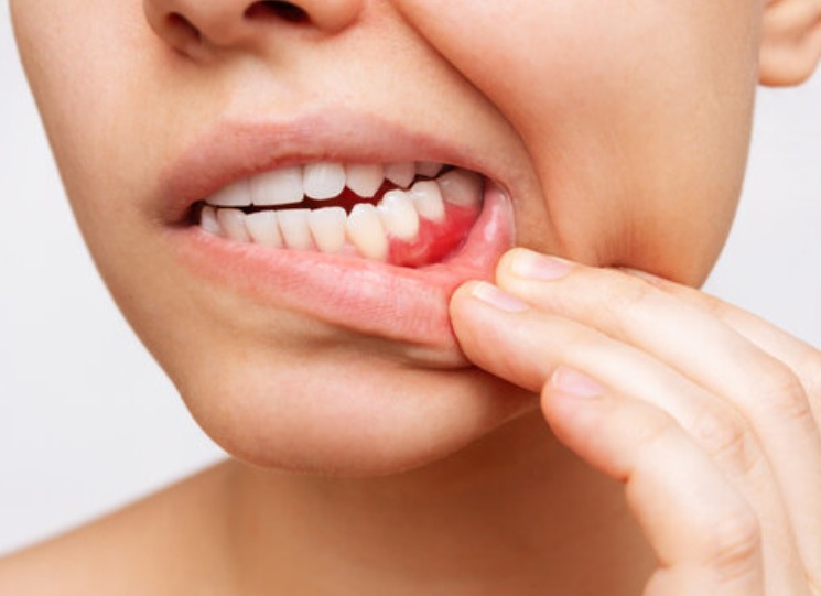 tratamiento periodoncia en granada